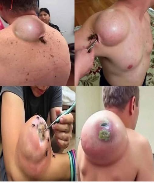 Incision and Drainage of a Sebaceous vs Epidermoid Cyst