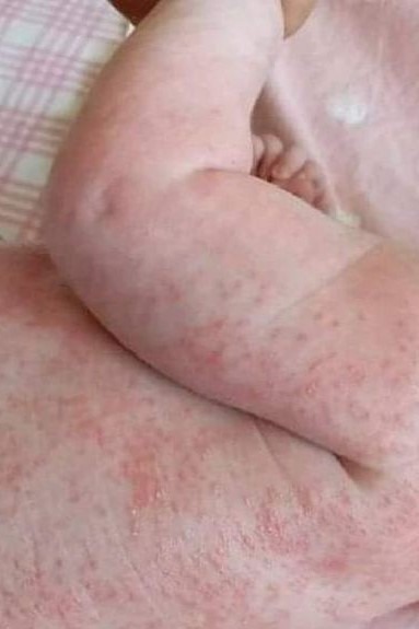 Please urgently follow the recommendations below. If no improvement is noticed within 24 hours, you must consult a pediatrician and begin appropriate medical treatment.