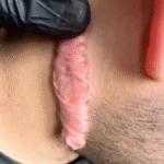 “Unusual Growth Behind the Ear Resembles Female Genitalia”