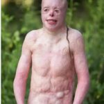 At 4-years-old This boy was caught in a fire that burned 95% of his body.