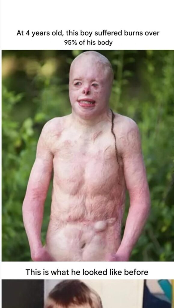 At 4-years-old This boy was caught in a fire that burned 95% of his body.