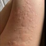 His whole body was itchy, he thought it was an allergy and was diagnosed w…See more
