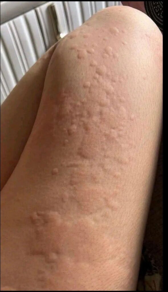 His whole body was itchy, he thought it was an allergy and was diagnosed w…See more