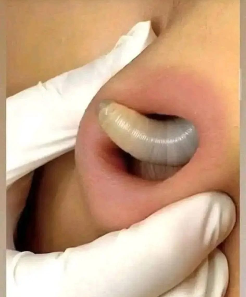 Larvae found in a young woman…See more