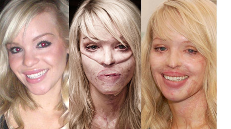 Tragic Acid Attack Survivor Katie Piper Becomes a Beacon of Hope and Awareness