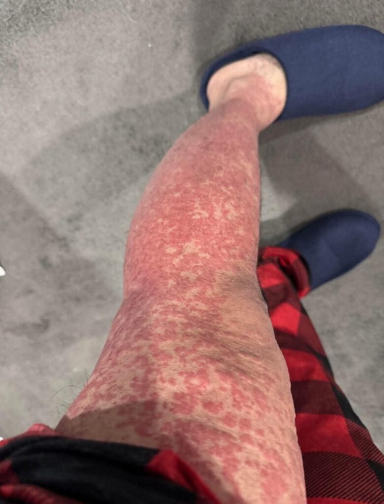 These are the consequences of sleeping with many…