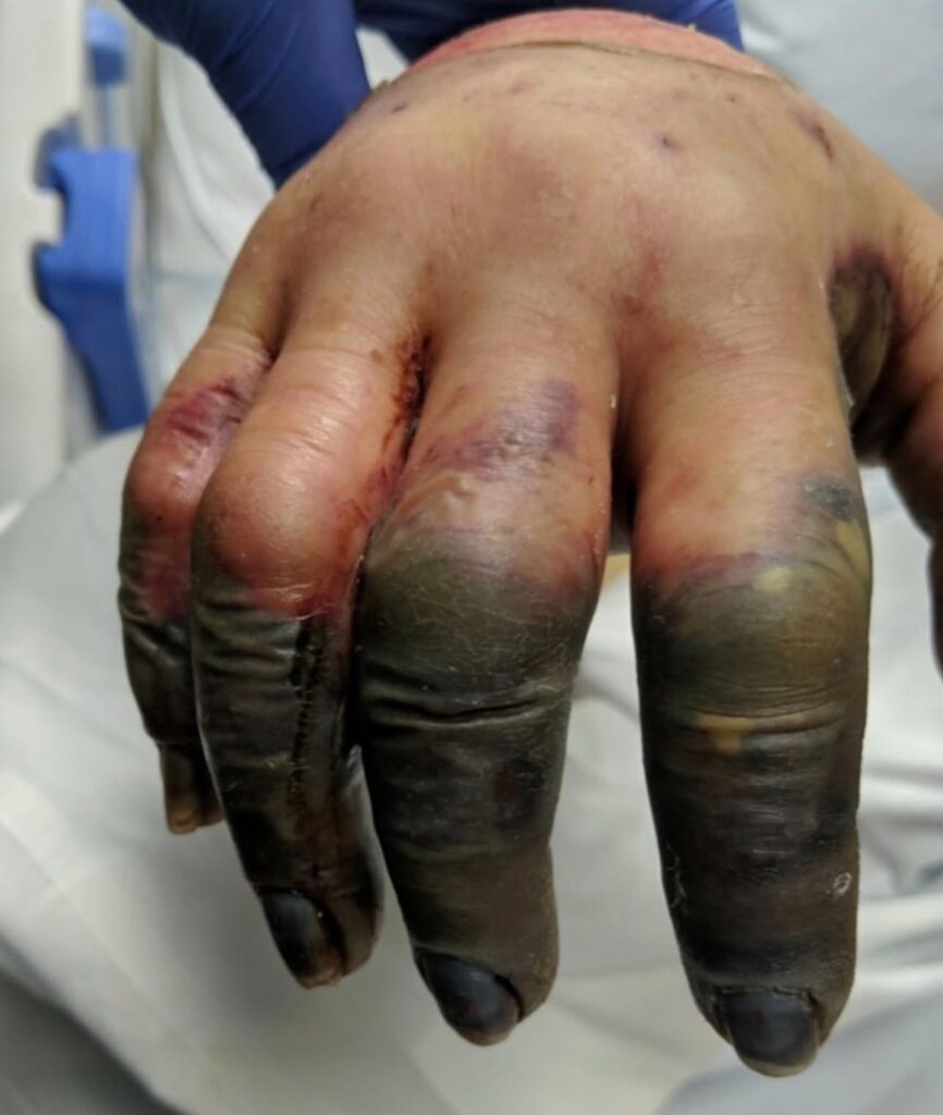 After this health problem, look at his hand in the hospital!