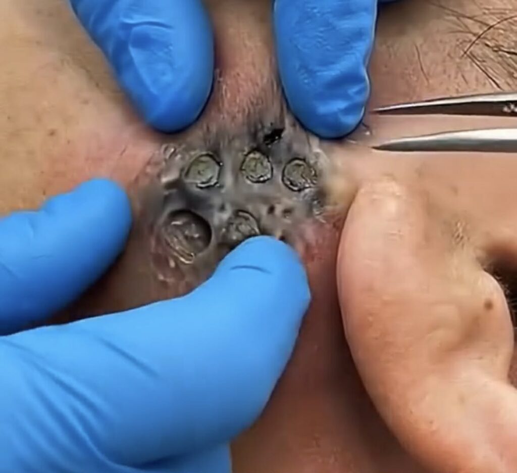 😱 Shocking Acne Extraction Leaves Doctors Speechless – You Won’t Believe This