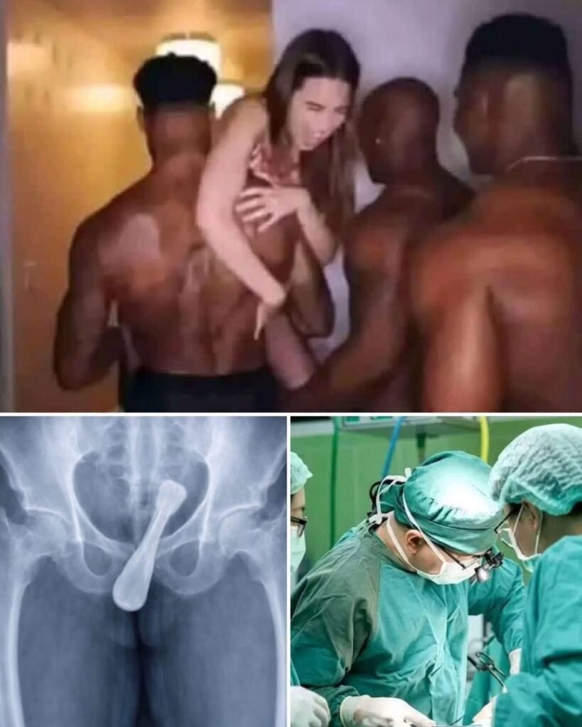A NIGHT OF PARTYING ENDED IN THE HOSPITAL: VIRAL IMAGE TRIGGERS WARNINGS ABOUT THE RISKS OF INSERTING OBJECTS INTO THE BODY